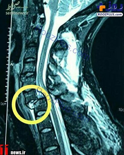 تصویری هولناک شکستگی از مهره گردن یک بازیکن!