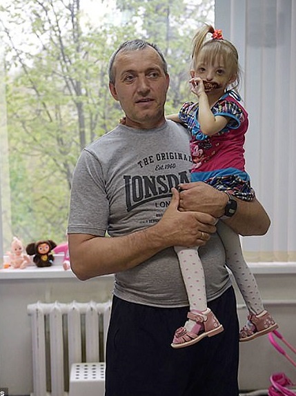 دختر بچه روسی بدون لب و چانه +تصاویر