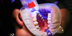 نسخه‌های خانگی برای درمان دندان درد