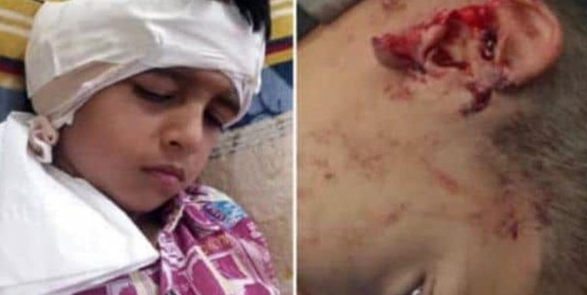 حمله سگ‌های ولگرد به کودک اهوازی/ گوش کودک آسیب‌دیده در بیمارستان گلستان پانسمان شد