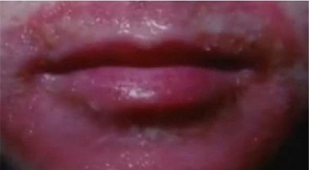 آلرژی به تلفن همراه +عکس آلرژی به تلفن همراه +عکس