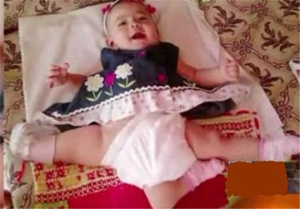 دختربچهای با ۳ پا + عکس دختربچهای با ۳ پا + عکس