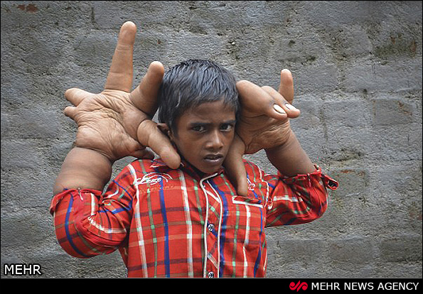 تصاویر/ کودک هندی با دستان غول پیکر‎
