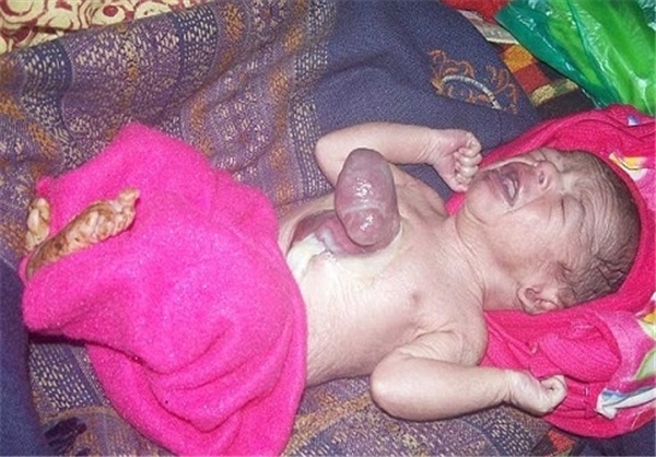 تولد نوزادی با قلبی خارج از بدن +عکس
