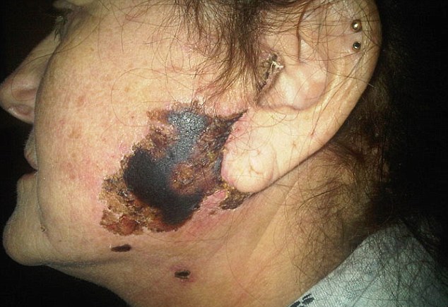 سوختگی وحشتناک پوستی بهای جراحی زیبایی + تصاویر سوختگی وحشتناک پوستی بهای جراحی زیبایی + تصاویر