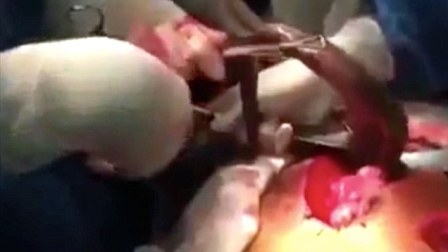 ماهی زنده در معده یک برزیلی+عکس