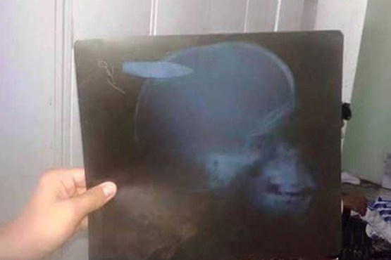 گلوله ای در سر یک کودک +عکس