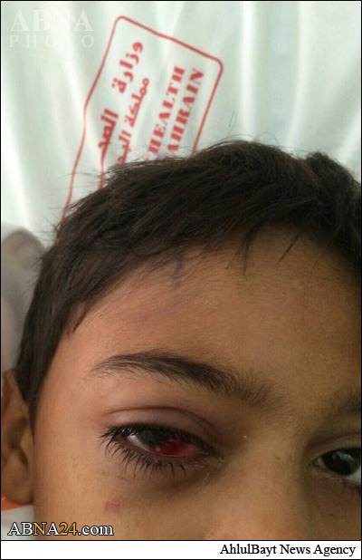 گلوله آل خلیفه بر چشم کودک بحرینی +عکس
