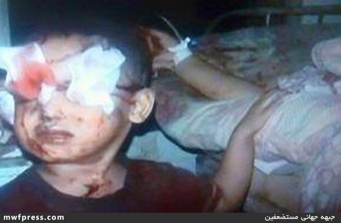 سعودی‌ها چشم کودک یمنی را گرفتند +عکس