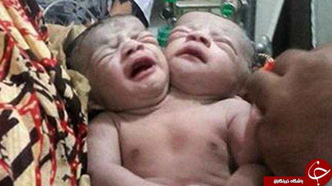 تولد نوزاد دو سر در بنگلادش +عکس