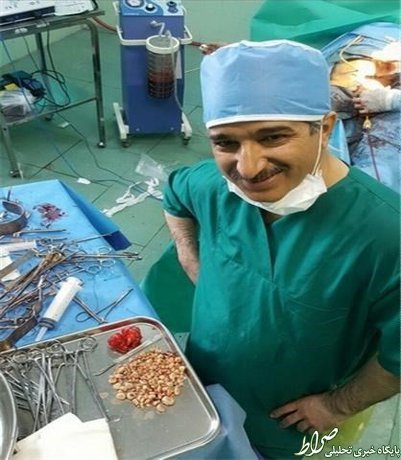 خروج 267 سنگ از مثانه یک بیمار + عکس خروج 267 سنگ از مثانه یک بیمار + عکس