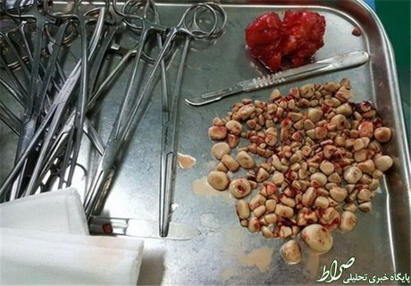 خروج 267 سنگ از مثانه یک بیمار + عکس خروج 267 سنگ از مثانه یک بیمار + عکس