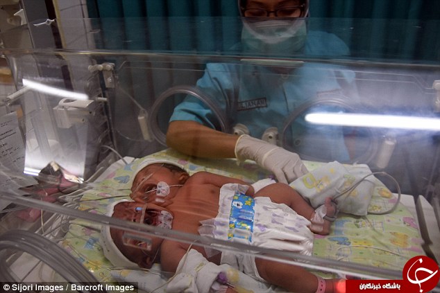 تولد نادر نوزاد 2 سر در اندونزی +تصاویر