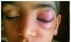 تنبیه بدنی دانش‌آموز را روانه بیمارستان کرد+تصاویر
