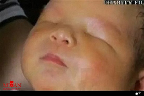 تولد نوزاد بدون چشم در چین+تصاویر