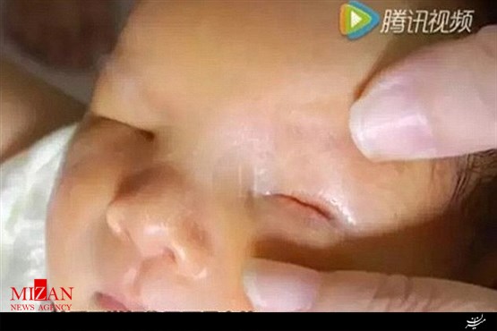 تولد نوزاد بدون چشم در چین+تصاویر تولد نوزاد بدون چشم در چین+تصاویر