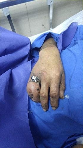 مصدومیت مردی با انگشتر تنگ +عکس مصدومیت مردی با انگشتر تنگ +عکس