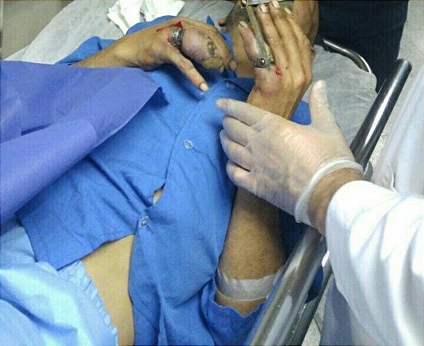 مصدومیت مردی با انگشتر تنگ +عکس مصدومیت مردی با انگشتر تنگ +عکس