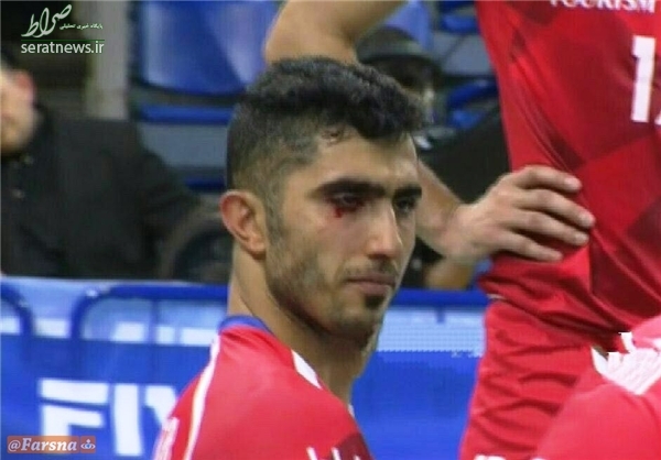 چشم میرزاجانپور دچار خونریزی شد +عکس چشم میرزاجانپور دچار خونریزی شد +عکس