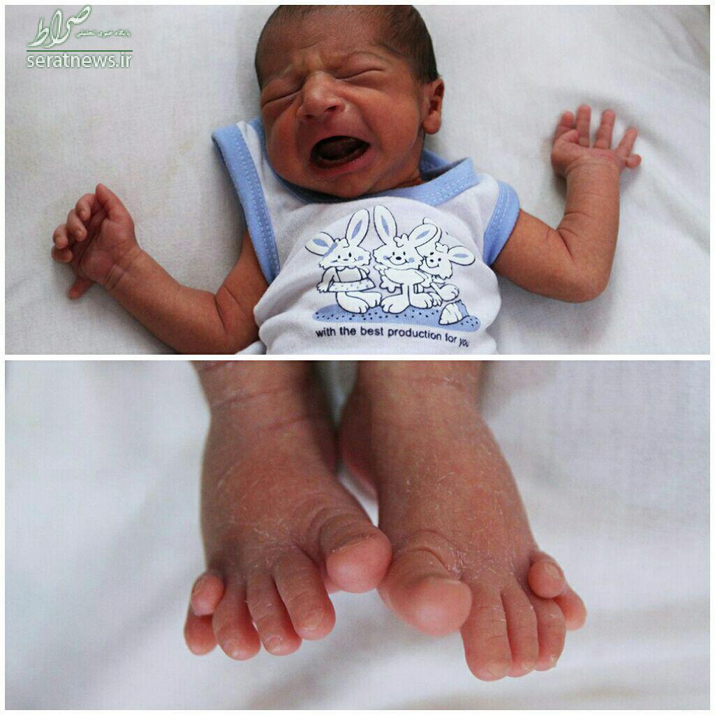 تولد نوزادی با ۲۴ انگشت در گناباد +عکس تولد نوزادی با ۲۴ انگشت در گناباد +عکس