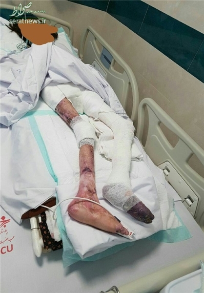 نفیسه دختر مبتلا به ایبی درگذشت +تصاویر دلخراش نفیسه دختر مبتلا به ایبی درگذشت +تصاویر دلخراش