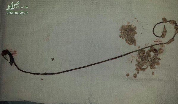 پزشک لوله 30 سانتی را در بدن بیمار جا گذاشت +عکس پزشک لوله 30 سانتی را در بدن بیمار جا گذاشت +عکس