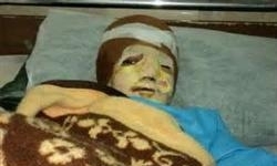 آخرین وضعیت درمانی کودک سوخته شده در دیگ نذری آخرین وضعیت درمانی کودک سوخته شده در دیگ نذری