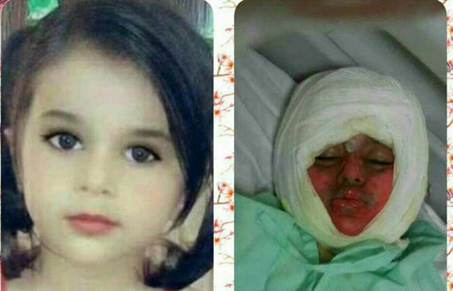 دخترک سوخته در دیگ نذری، جان سپرد دخترک سوخته در دیگ نذری، جان سپرد