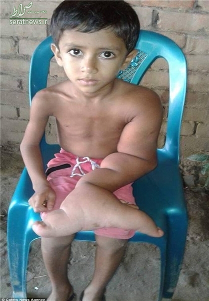 دست عجیب پسر 5 ساله بنگلادشی+عکس