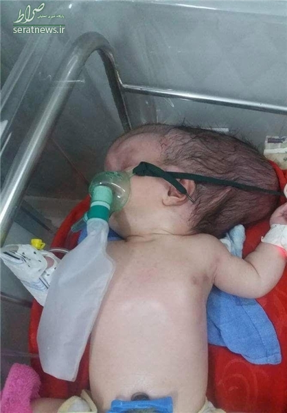 جمجمه این نوزاد نصفه است +تصاویر