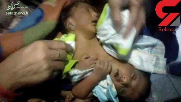 تولد دوقلوهای به هم چسبیده عجیب! +عکس تولد دوقلوهای به هم چسبیده عجیب! +عکس
