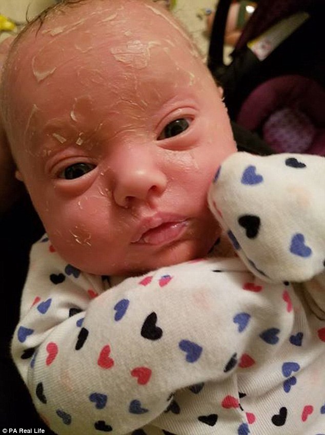 این نوزاد هفته ای یک بار پوست می اندازد +عکس