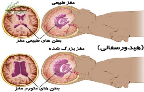 کدام بیماری کله آدمیزاد را بزرگ می‌کند؟ +تصاویر