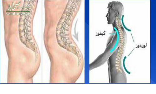 ورزش های مناسب برای درمان گودی کمر +تصاویر