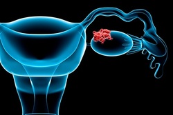 از نشانه‌های ظریف سرطان تخمدان که شاید نادیده گرفته شوند