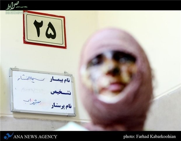اسیدپاشی فجیع در غرب تهران +عکس
