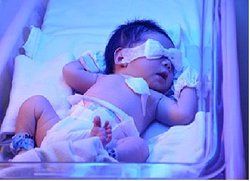 تشخیص سریع زردی نوزادان با راهکار محققان کشور