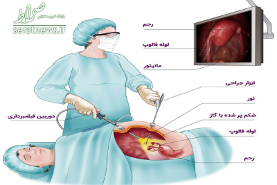 آشنایی با نحوه انجام لاپاراسکوپی رحم و شکم +تصاویر