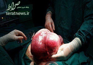 خارج کردن توده پنج کیلویی از شکم دختر ۱۳ ساله‌ +عکس