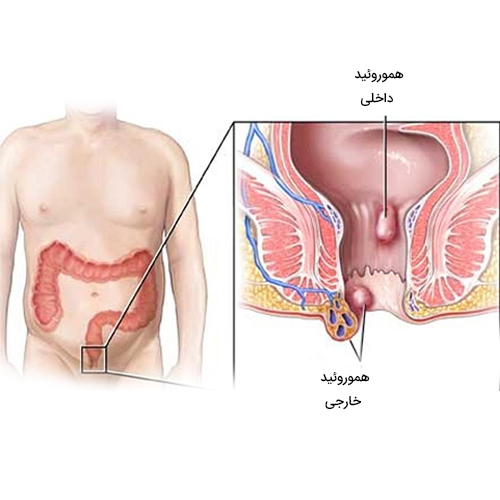 راه های سریع درمان هموروئید خونی و جلوگیری از خونریزی