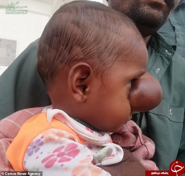 تولد کودک پاکستانی با زائدهای وحشتناک روی صورت +تصاویر تولد کودک پاکستانی با زائدهای وحشتناک روی صورت +تصاویر