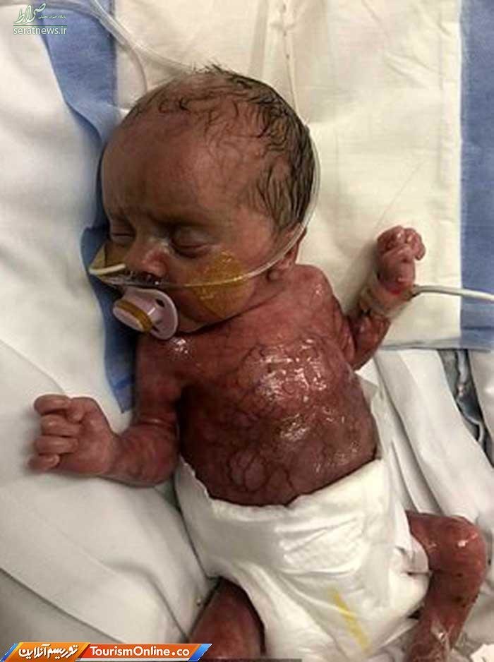 تولد نوزاد بدون پوست در بیمارستان ناتینگهام +تصاویر
