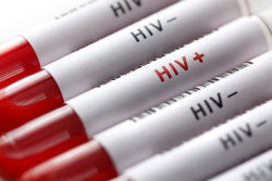 آمار بیماران مبتلا به «HIV» در استان ایلام اعلام شد