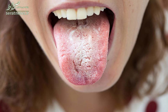 علائم برفک دهان کدامند؟