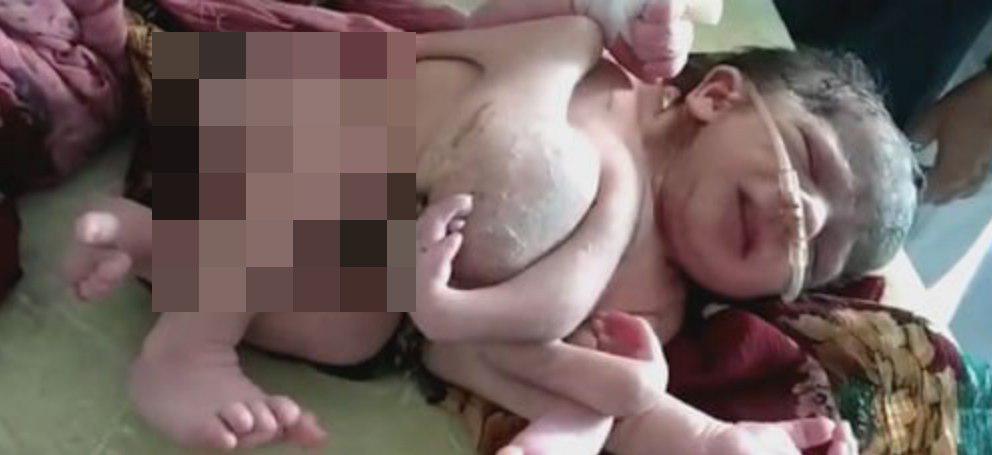 تولد نوزادی عجیب با چهار پا، پزشکان را شوکه کرد! +عکس