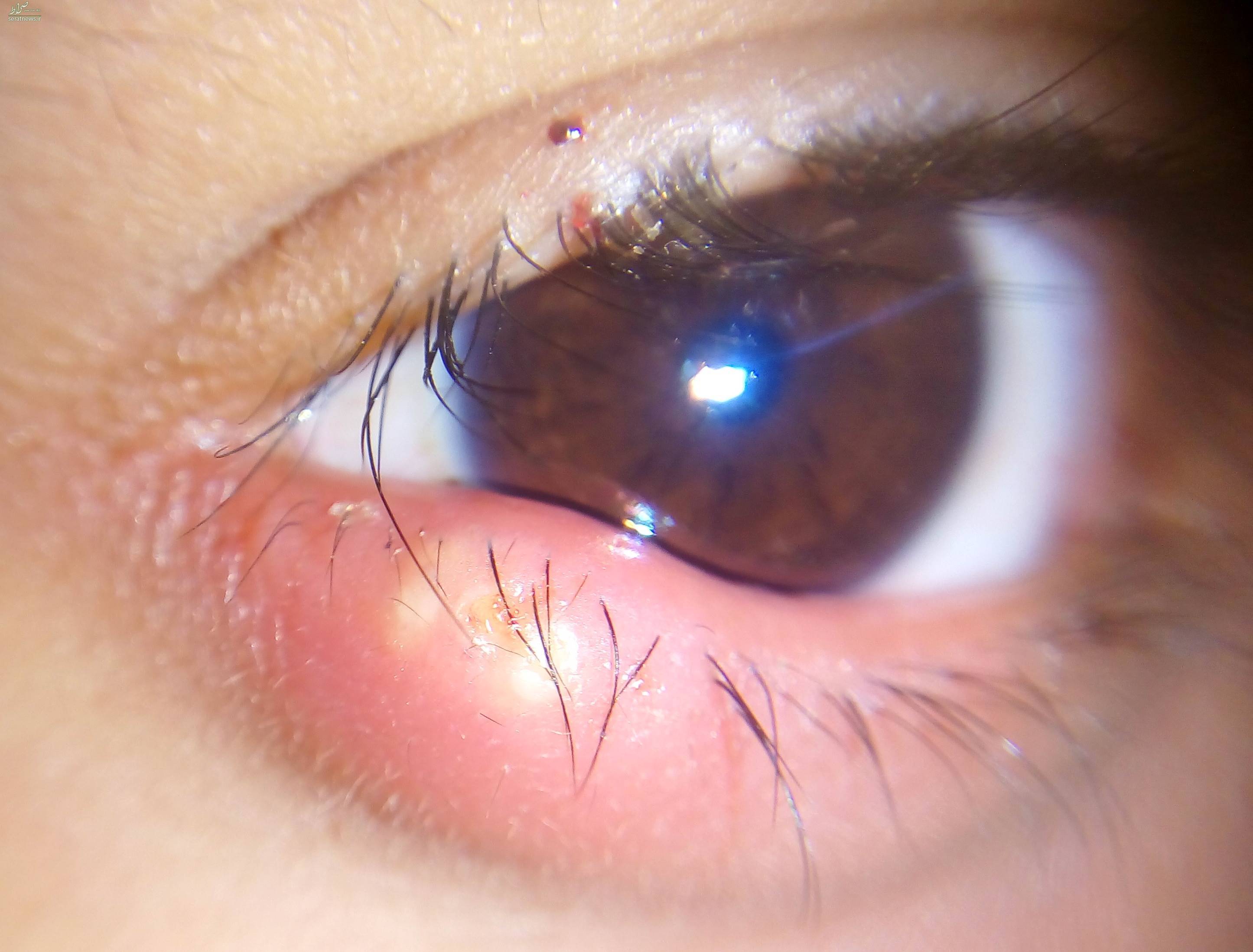 شایع‌ترین بیماری‌های چشمی را بشناسید +تصاویر