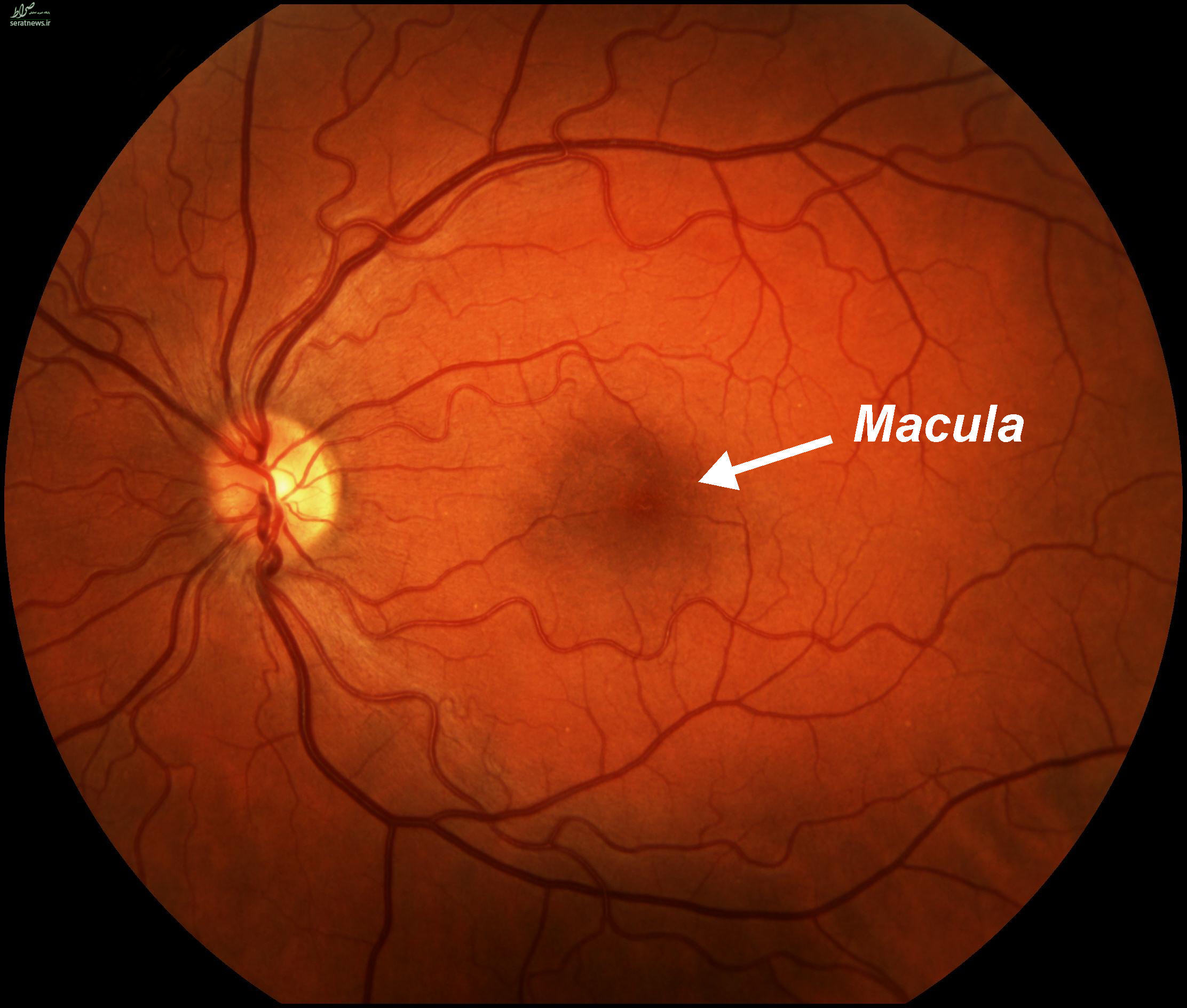 شایع‌ترین بیماری‌های چشمی را بشناسید +تصاویر