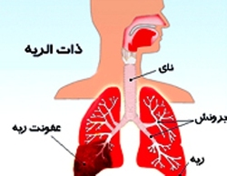 زنگ هشدار شیوع بیماری ذات الریه به صدا در آمد