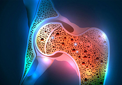 راه‌های جلوگیری از بروز پوکی استخوان