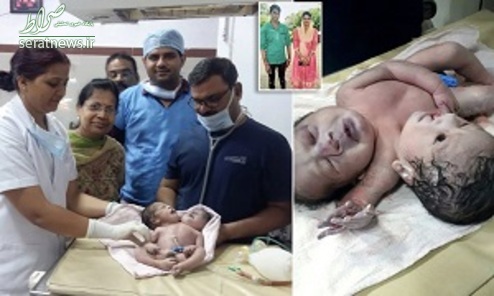 تولد نوزاد دو سر در هندوستان! +تصاویر
